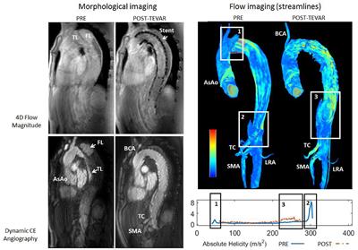 Frontiers | Hemodynamic Changes Before And After Endovascular Treatment ...